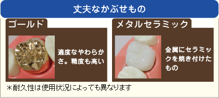 丈夫なかぶせもの